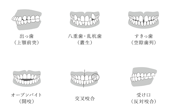 出っ歯 （上顎前突）八重歯・乱杭歯 （叢生）すきっ歯 （空隙歯列）オープンバイト （開咬）交叉咬合 受け口 （反対咬合）