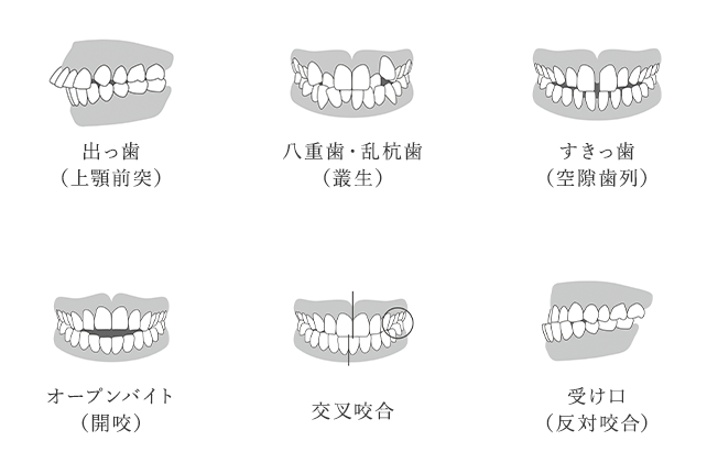 出っ歯 （上顎前突）八重歯・乱杭歯 （叢生）すきっ歯 （空隙歯列）オープンバイト （開咬）交叉咬合 受け口 （反対咬合）